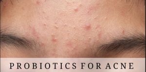 Probiotics for acne