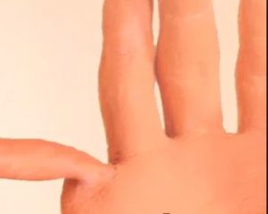 Fractured Finger